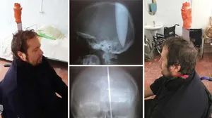 Burnundan nefes alamadı başını deldi